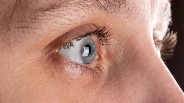 קרטוקונוס